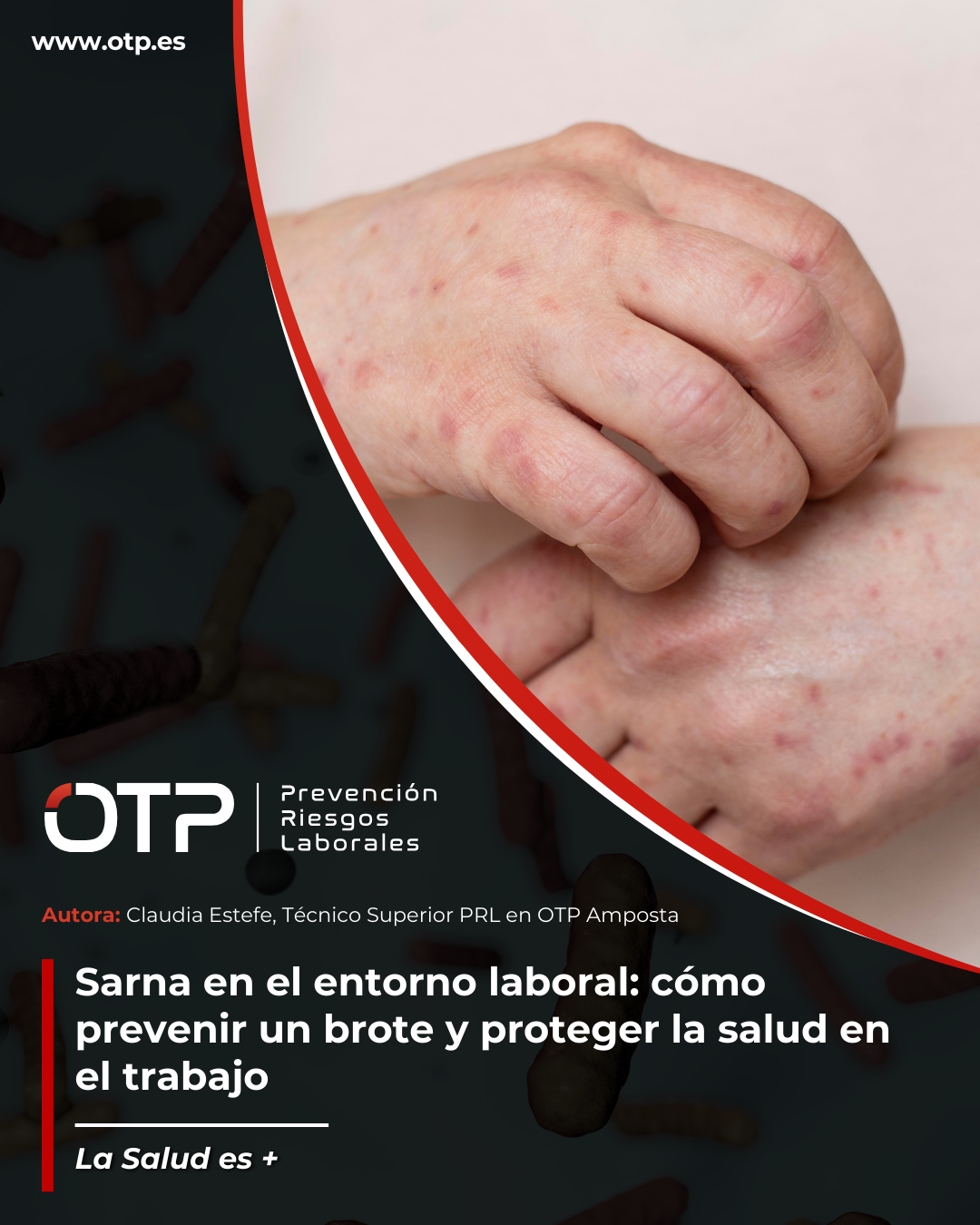 Sarna en el entorno laboral: cómo prevenir un brote y proteger la salud en el trabajo